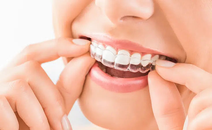 woman holding clear aligner to teeth